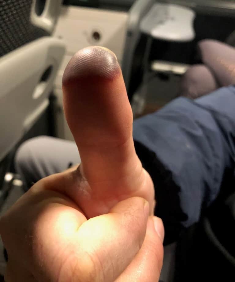 Backpacking In Cold Weather Tips 2 Frostbitten thumb